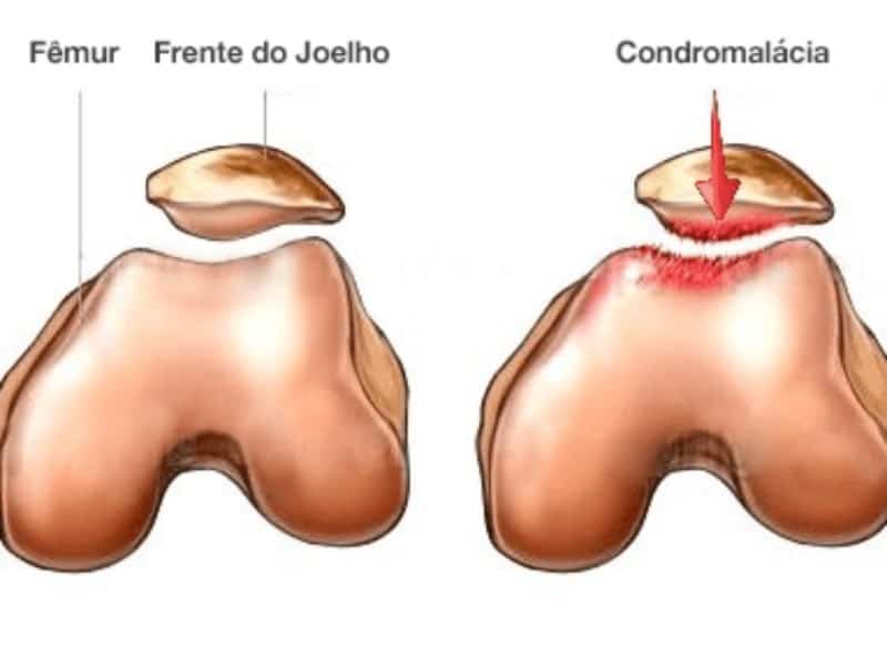 Condromalácia Patelar