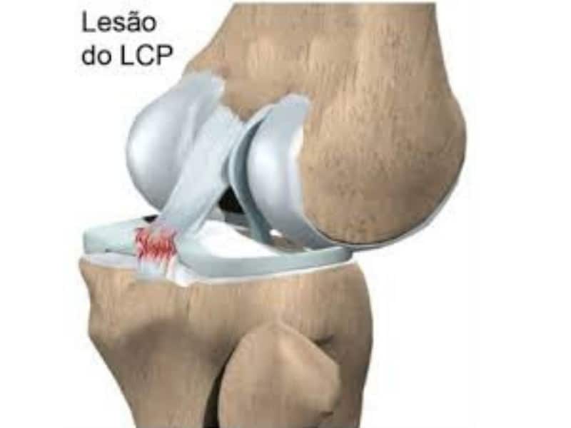 Ligamento Cruzado Posterior