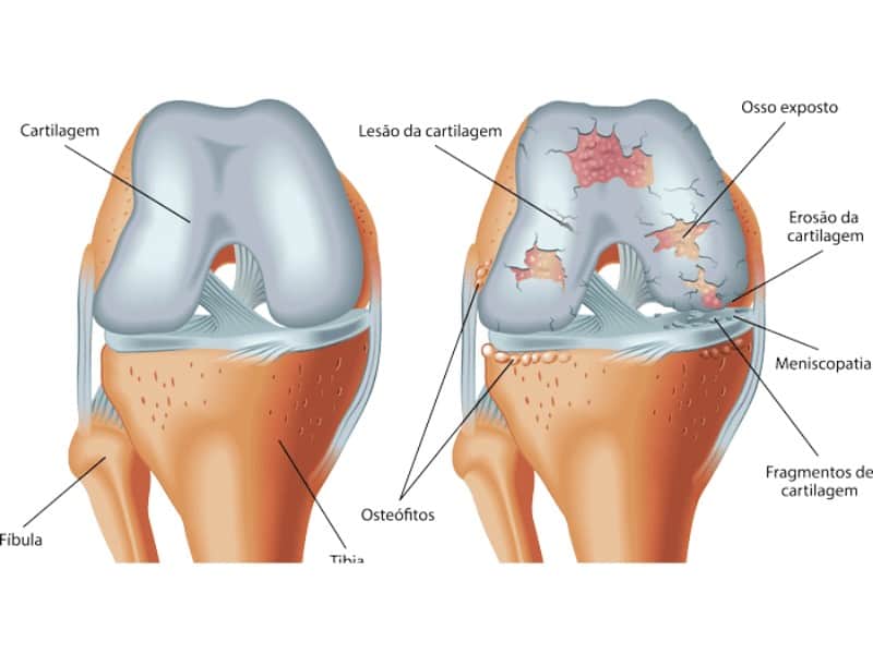 Osteoartrite / Osteoartrose